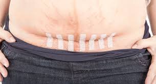 The staples aren't holding your stomach together. C Section Recovery Timeline Aftercare And Expectations Babycenter