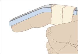 Image result for Volar PIP Dislocation