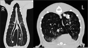 Image result for Broncholithiasis