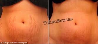 This tattoo artist makes stretch marks disappear before your eyes. Hate Your Stretch Marks Artist Makes Them Disappear Instantly By Using Flesh Coloured Tattoos To Create Optical Illusion Of Flawless Skin Daily Mail Online