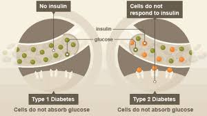Type 1 diabetes is an autoimmune disorder in which the body's own immune system attacks the beta cells in the pancreas, destroying them or damaging them sufficiently to significantly reduce the production of insulin. Drug That Mimics Exercise Might Help With Type 2 Diabetes