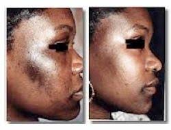 Should African American Skin Get Microdermabrasion Hyperpigmentation Black Skin Microdermabrasion Hyperpigmentation Treatment