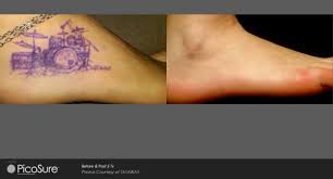 In the end, lasering the tattoo was the most first week after trying home tattoo removal methods. Laser Tattoo Removal Before After Photos Winston Salem Nc