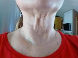 Unflatteringly called turkey neck, as we get older, the skin on the neck can droop largely due to skin losing its elasticity, weakened neck muscles, and even here are 6 steps to help naturally get rid of turkey neck (or better yet, help prevent it from forming in the first place): How Can I Get Firmer Facial Muscles And Get Rid Of Turkey Neck And Jowls Help