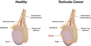 But testicular cancer is the most common cancer in american males between the ages. Testicular Cancer Awareness Month