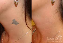 The cost of laser tattoo removal may be high compared to other tattoo removal methods. Omaha Cosmetic Surgery Tattoo Removal Skin Specialists Pc Lovelyskin