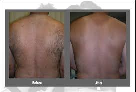Laser hair removal is one of the most popular ways to reduce unwanted hair. Laser Hair Removal Cost Before After Faq Hartford Ct