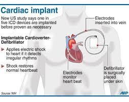 Infographic On Defibrillator Implantable Cardioverter Defibrillator Cardiac Nursing Infographic Health