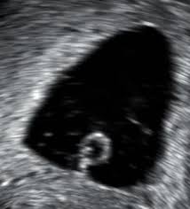 Aborto Espontaneo Wikipedia La Enciclopedia Libre