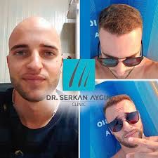 Before After Hair Transplantation Sac Ekimi Oncesi Ve Sonrasi Sacekimi Sacekimiuzmani Sacekimmerkezi Sacekimioncesi Sacekimisonrasi Drserkanaygin Ha Sac