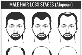 Removing the tension on the hair follicle will stop. Hair Loss Stages And Types Of Baldness Man Hairs Problem Vector Chart By Microvector Thehungryjpeg Com