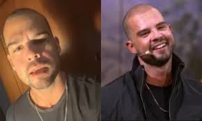 Calvo do Casamento às Cegas faz transplante capilar; veja mudança