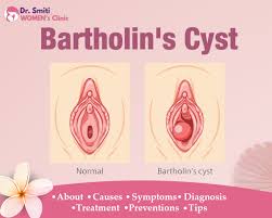 Image result for Bartholin's gland abscess