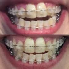 The bright side, in addition to a beaming smile once the braces have been removed, is that there are various ways to pay for braces, rather than depleting your savings account or asking family to foot the bill. How To Straighten Teeth Without Braces Reddit Teethwalls