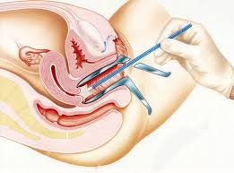 Image result for Cervical Cancer Screening