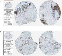 Learn about the types of colorectal cancer, how they start, and where they grow. What Color Represents Rectal Cancer