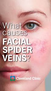 Massage encourages circulation, helping blood to flow more freely through your capillaries. How Can I Get Rid Of The Spider Veins On My Face Facial Spider Veins Spider Veins Spider Veins Face