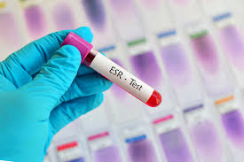 What Is Esr In Blood Test Means And How It Is Can Help