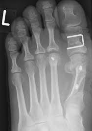 Wählen sie ihre zeit für eine hallux valgus operation. Arthromed Praxisklinik Chemnitz Fussoperationen