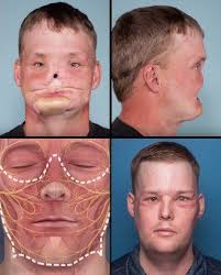 Before And After Andy Sandness Face Transplant The Incredibles Face Faith In Humanity
