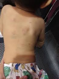 Keadaan fizikal meneliti setiap bahagian anggota tubuh badan adalah penting bagi mengenal pasti berlaku perubahan. Kesan Penderaan Kanak Kanak Terhadap Perkembangan Emosi Fizikal Theasianparent Malaysia