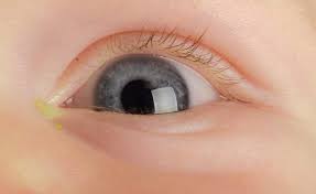 Image result for Eye Discharge