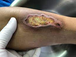 Assessment And Management Of Wound Odor | Wound Management