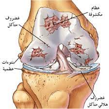 علاج كيس الغضروف الهلالي للركبةد. Ø¹Ù…Ù„ÙŠØ© Ø§Ù„ØºØ¶Ø±ÙˆÙ Ø§Ù„Ù‡Ù„Ø§Ù„ÙŠ Ù„Ù„Ø±ÙƒØ¨Ø© ÙˆØ§Ù„Ø¥Ø¬Ø±Ø§Ø¡Ø§Øª Ø§Ù„Ù…ØªØ¨Ø¹Ø© Ù‚Ø¨Ù„ Ø§Ù„Ø¹Ù…Ù„ÙŠØ© Ù…Ø¯ÙˆÙ†Ø© Ø¨ÙˆÙƒ Ø¯ÙˆÙƒ