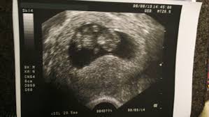 Ssw ist das erste trimester der schwangerschaft abgeschlossen. 3 Ultraschallbild 10 Ssw 9 6 Meine Erste Schwangerschaft