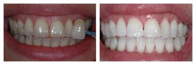 We did not find results for: Teeth Whitening Manchester Tooth Whitening Treatment Kissdental