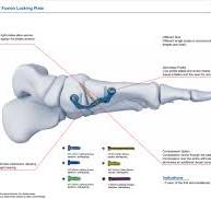 MT First MTC Plantar Fusion Locking Plate,Medical Device ...