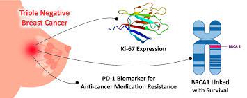 Breast cancer treatment triple negative. Triple Negative Breast Cancer Biology Pathology And Treatment