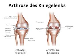 Wie Aussert Sich Arthrose Am Knie Und Wie Wird Behandelt