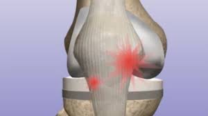 Knee Revision When Your Knee Replacement Must Be Replaced