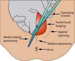 Episiotomy Wikipedia