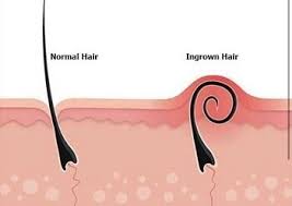 Here are pictures, removal, treatment for infected cysts and how to eliminate ingrown hair roots cysts naturally. Ingrown Hairs A Painful Problem Aspen Hair Beauty Laser Hair Removal