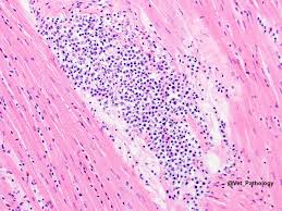 From animal models of cardiac inflammation we have detailed insight of the strain specific immune. Veterinary Pathology On Twitter Necrotizing Myocarditis In A Bird Heart Wildlife Veterinary Vetpath