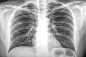 Image result for Lung Cancer
