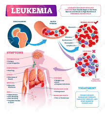 When bone marrow and cancer are said together in the same breath, there are many different possibilities, and each can have it's own meanings and consequences. Leukemia Vector Illustration Labeled Educational Blood Cancer Royalty Free Cliparts Vectors And Stock Illustration Image 139354752
