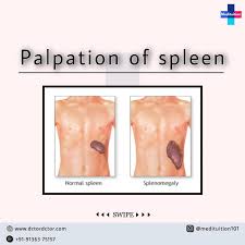 Image result for Splenomegaly