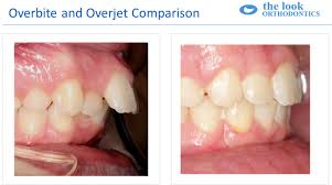 She got braces from the orthopedic surgeon and rhumetologist. Getting Orthodontic Separators The Look Orthodontics