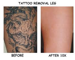 You have to take proper care of treated. Laser Treatment For Tattoo Removal All You Need To Know Before Undergoing One Nayouquan