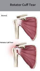 A tear can occur if a person tries to pick up a heavy object with a straight arm, putting excess pressure on the tendon and stretching it beyond the normal range of motion. 2f0h6vdqevb0qm