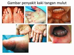 Akan tetapi kalau mau lebih tahan lama, gambarnya memang. Cik Cerry Penyakit Kaki Tangan Mulut Hmfd