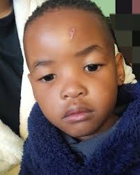 Using Vitamin E Oil to Reduce Scar Tissue After Plasma Donation