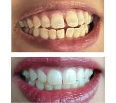 Veneers Case 2
