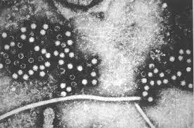 Hepatitis E Wikipedia