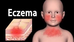 Image result for ekzema face