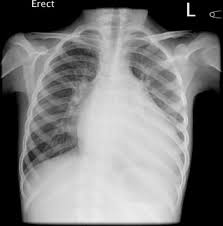 Image result for XRay Changes in Rheumatic Conditions