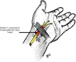 Acute Carpal Tunnel Syndrome In Trauma Springerlink